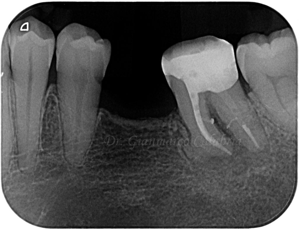 Caso Clinico Endodontico
