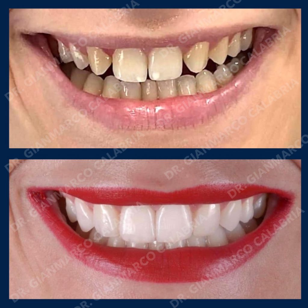 Stratificazione diretta in composito dei denti anteriori in giovane Paziente, con Agenesia degli incisivi laterali, eseguita col fine di migliorare l’estetica del suo sorriso