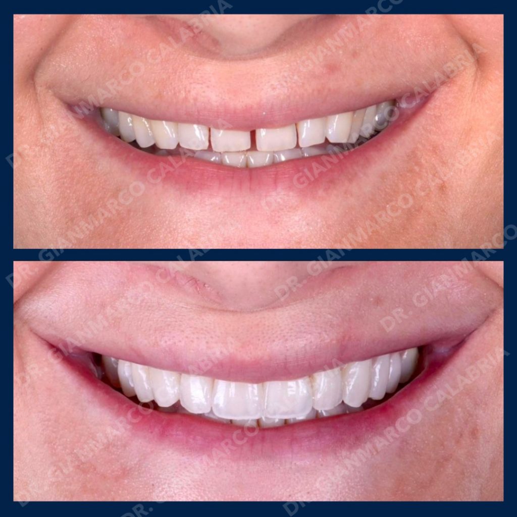 Caso multidisciplinare con fase iniziale ortodontica ( fatta con mascherine trasparenti) E finalizzazione estetica con 10 FACCETTE stratificate in ceramica per migliorare colore, forma e volumi dei denti naturali.